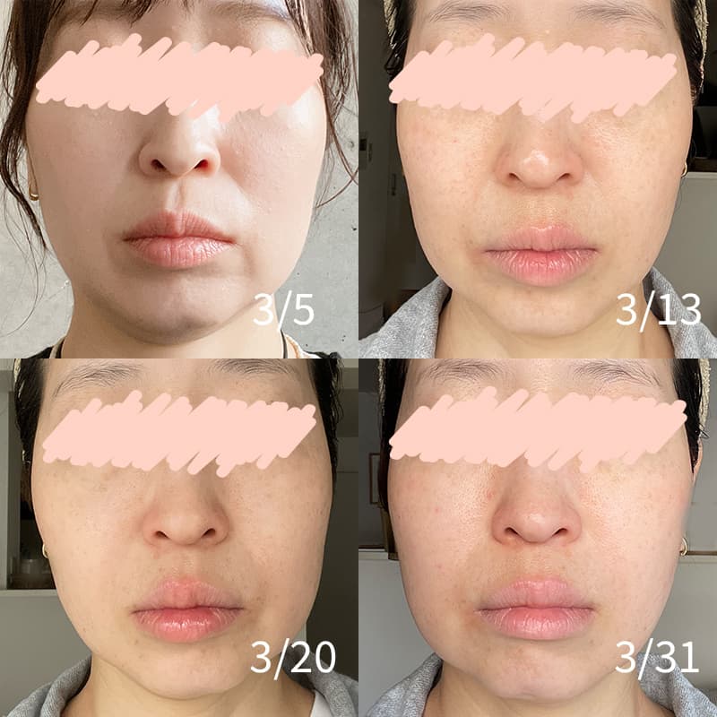 ZIIP HALO 2.0 美顔器