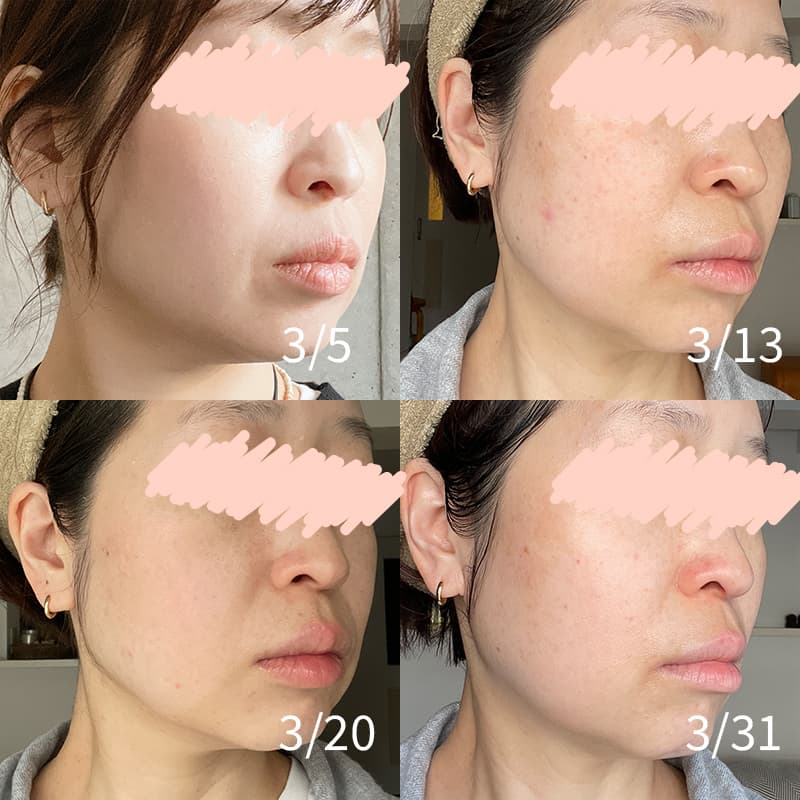 ZIIP HALO 2.0 美顔器