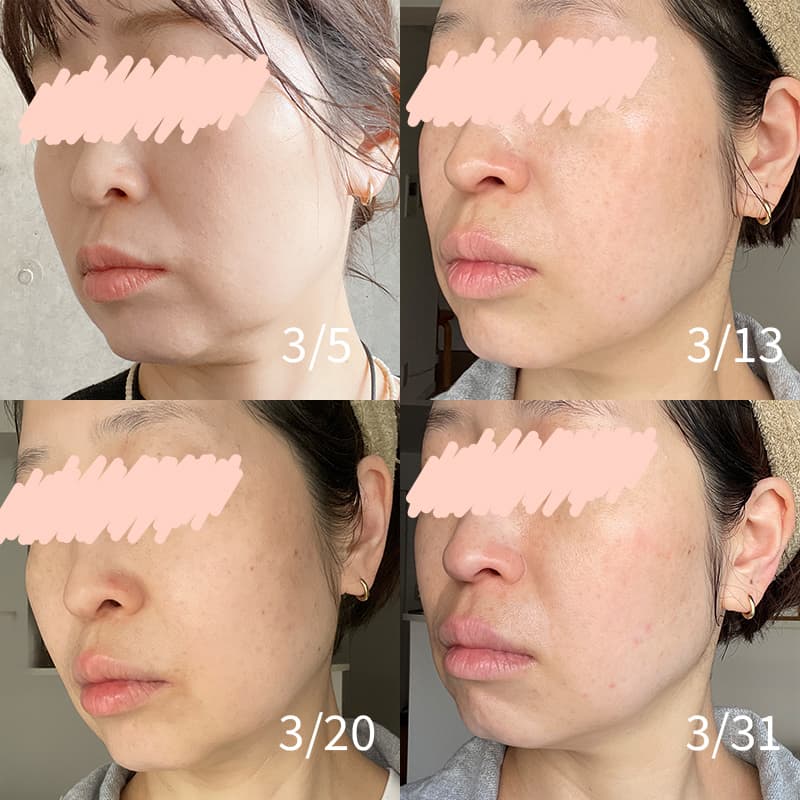 ZIIP HALO 2.0 美顔器